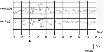 Effects of External Auditory Meatus Occlusion on Ocular Vestibular Evoked Myogenic Potentials Induced by Bone Conducted Sound